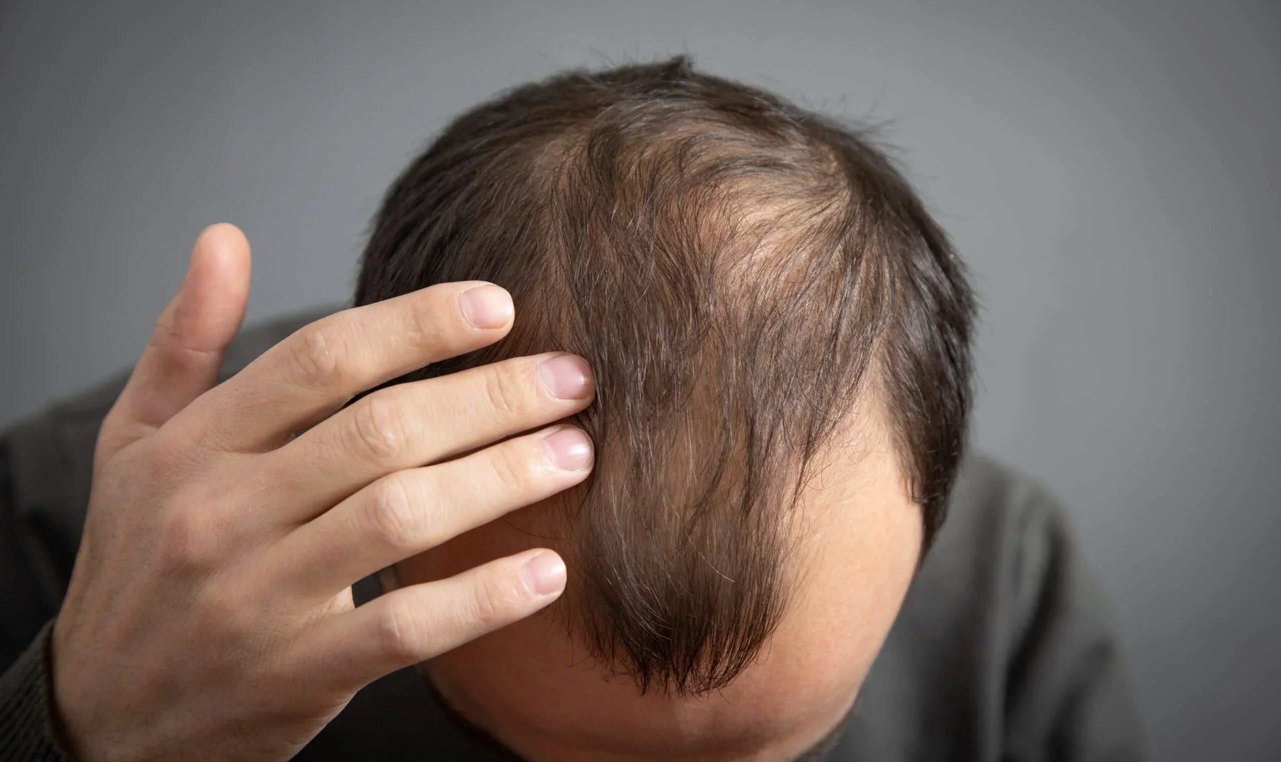 Understanding Hair Loss Types: Causes and Solutions